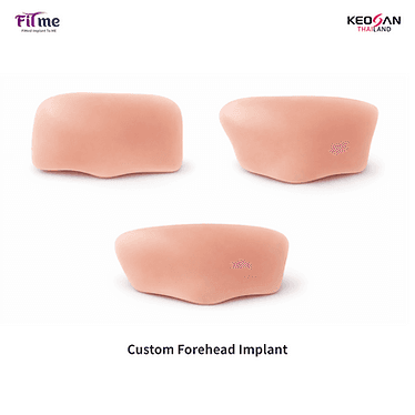 Ví dụ implant cá nhân hóa FITme vùng trán từ tài liệu sản phẩm