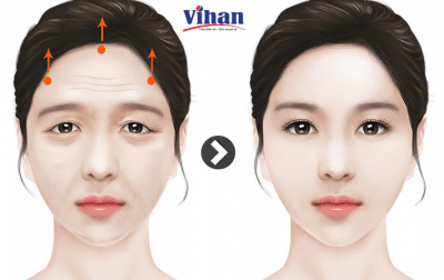 Ảnh lưu trữ bài viết Endotine-Biobsorb Fixtine - Dụng Cụ Sinh Học Tự Tiêu Đột Phá Trong Kỹ Thuật Căng Da Mặt